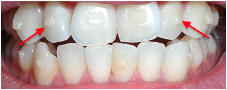 "How Attachments Help Aligners Work Better – Explained Simply"